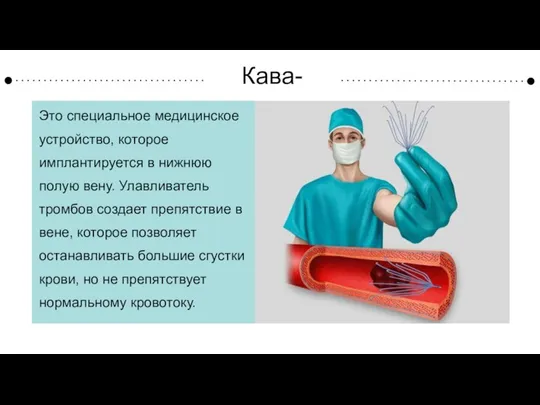 Кава-фильтр Это специальное медицинское устройство, которое имплантируется в нижнюю полую вену. Улавливатель