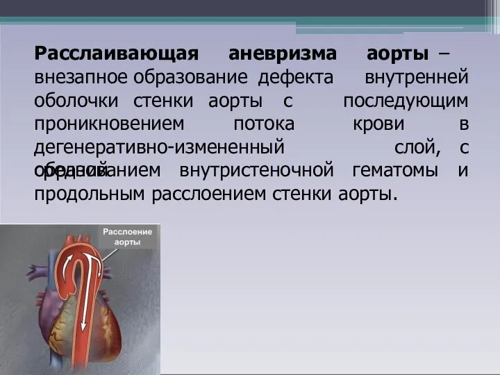 Расслаивающая аневризма внезапное образование дефекта аорты – внутренней последующим оболочки стенки аорты