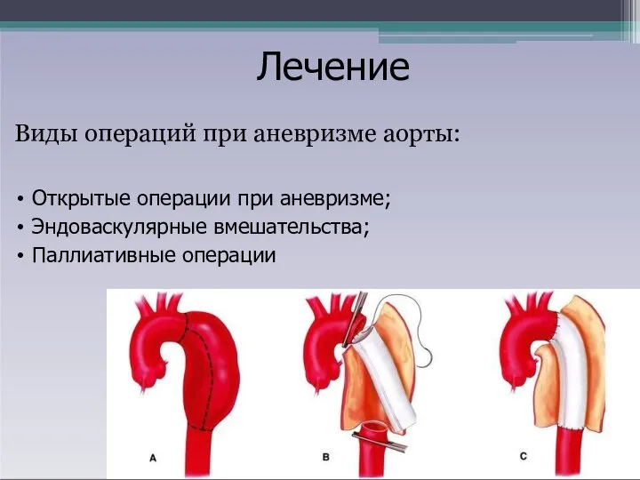 Виды операций при аневризме аорты: Открытые операции при аневризме; Эндоваскулярные вмешательства; Паллиативные операции Лечение