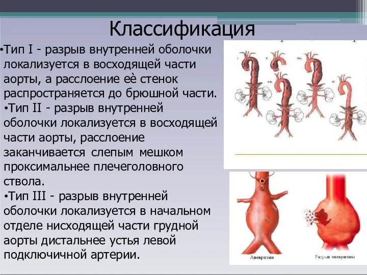 Классификация Тип I - разрыв внутренней оболочки локализуется в восходящей части аорты,