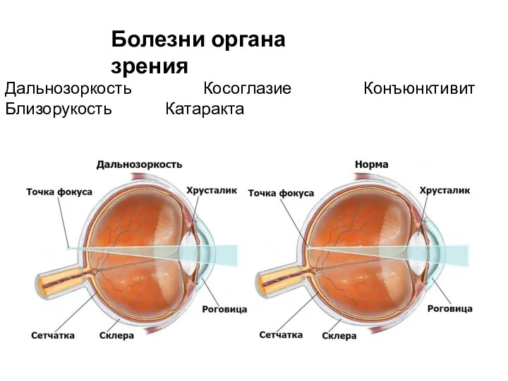 Дальнозоркость Косоглазие Конъюнктивит Близорукость Катаракта Болезни органа зрения