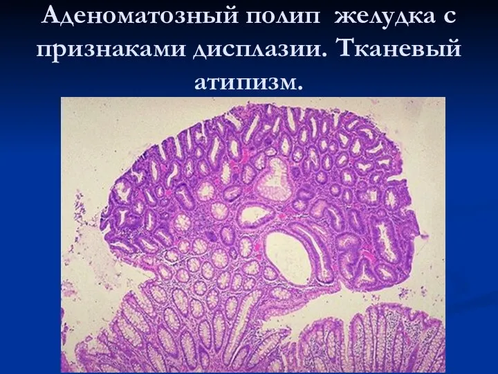 Аденоматозный полип желудка с признаками дисплазии. Тканевый атипизм.