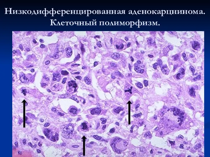 Низкодифференцированная аденокарцнинома. Клеточный полиморфизм.