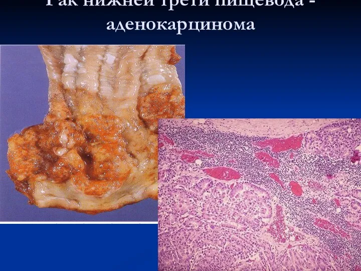 Рак нижней трети пищевода - аденокарцинома