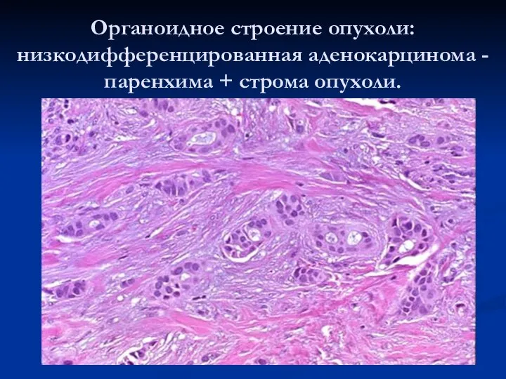 Органоидное строение опухоли: низкодифференцированная аденокарцинома - паренхима + строма опухоли.