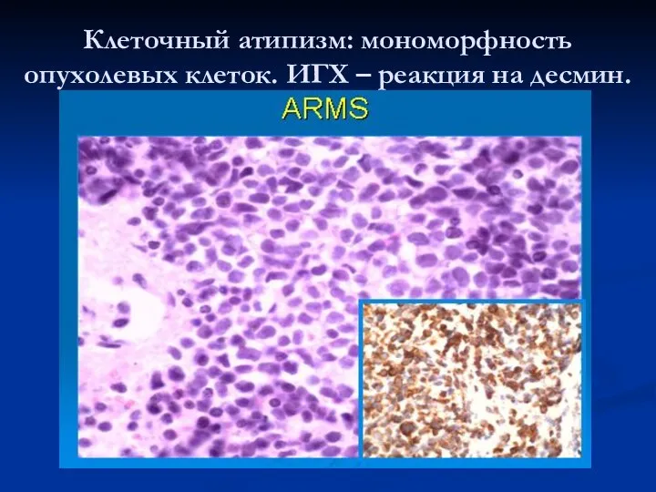 Клеточный атипизм: мономорфность опухолевых клеток. ИГХ – реакция на десмин.