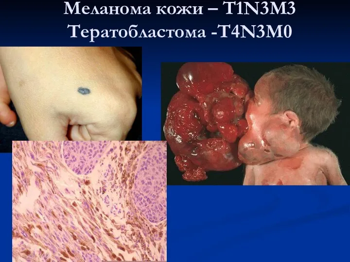 Меланома кожи – T1N3M3 Тератобластома -T4N3M0
