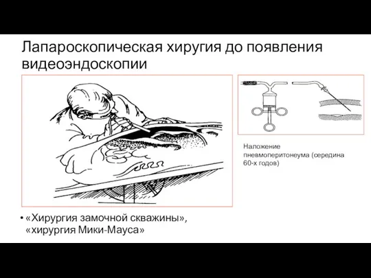 Лапароскопическая хиругия до появления видеоэндоскопии «Хирургия замочной скважины», «хирургия Мики-Мауса» Наложение пневмоперитонеума (середина 60-х годов)