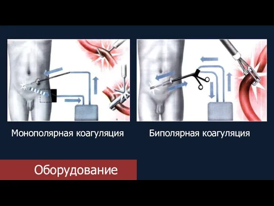 Оборудование Монополярная коагуляция Биполярная коагуляция