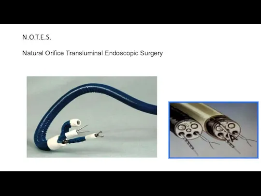 N.O.T.E.S. Natural Orifice Transluminal Endoscopic Surgery