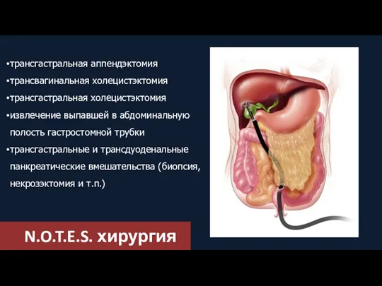 N.O.T.E.S. хирургия трансгастральная аппендэктомия трансвагинальная холецистэктомия трансгастральная холецистэктомия извлечение выпавшей в абдоминальную