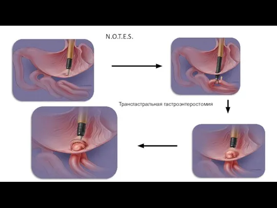 N.O.T.E.S. Трансгастральная гастроэнтеростомия
