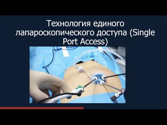 Технология единого лапароскопического доступа (Single Port Access)