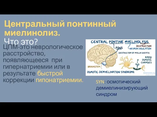 Центральный понтинный миелинолиз. Что это? ЦПМ-это неврологическое расстройство, появляющееся при гипернатриемии или