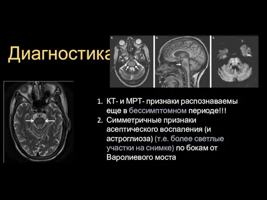 Диагностика КТ- и МРТ- признаки распознаваемы еще в бессимптомном периоде!!! Симметричные признаки