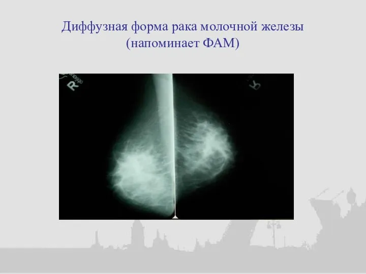 Диффузная форма рака молочной железы (напоминает ФАМ)