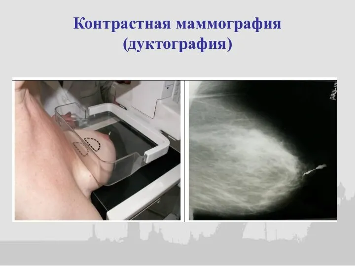 Контрастная маммография (дуктография)