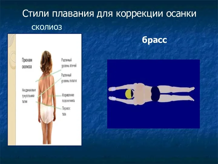 сколиоз брасс Стили плавания для коррекции осанки