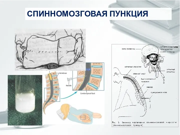 СПИННОМОЗГОВАЯ ПУНКЦИЯ