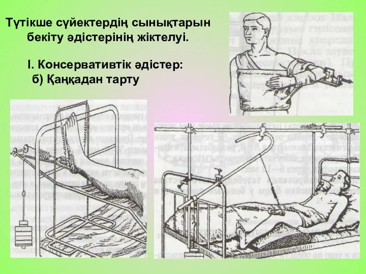 Түтікше сүйектердің сынықтарын бекіту әдістерінің жіктелуі. І. Консервативтік әдістер: б) Қаңқадан тарту