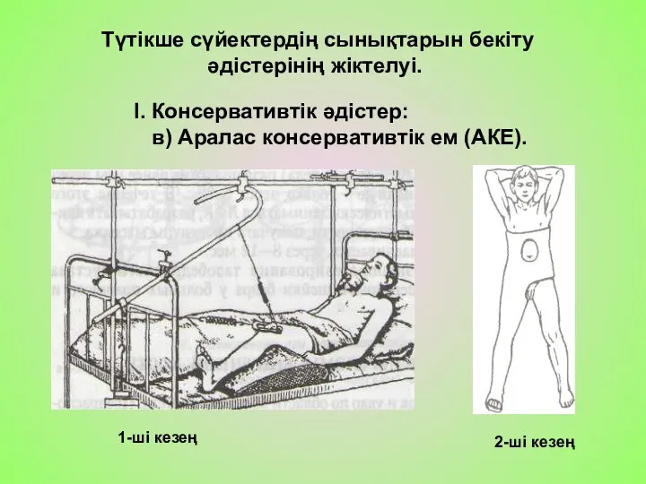 Түтікше сүйектердің сынықтарын бекіту әдістерінің жіктелуі. І. Консервативтік әдістер: в) Аралас консервативтік ем (АКЕ).