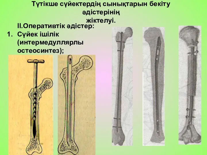 II.Оперативтік әдістер: Сүйек ішілік (интермедуллярлы остеосинтез); Түтікше сүйектердің сынықтарын бекіту әдістерінің жіктелуі.