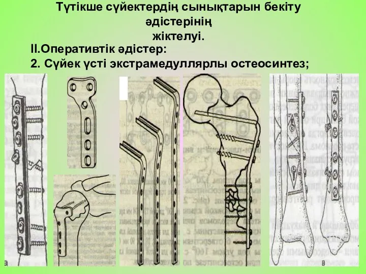 II.Оперативтік әдістер: 2. Сүйек үсті экстрамедуллярлы остеосинтез; Түтікше сүйектердің сынықтарын бекіту әдістерінің жіктелуі.