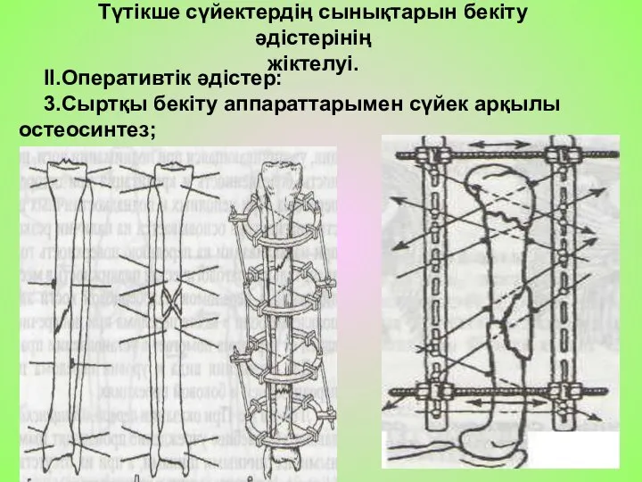 Түтікше сүйектердің сынықтарын бекіту әдістерінің жіктелуі. II.Оперативтік әдістер: 3.Сыртқы бекіту аппараттарымен сүйек арқылы остеосинтез;