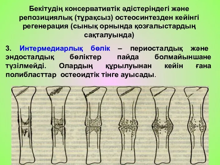 Бекітудің консервативтік әдістеріндегі және репозициялық (тұрақсыз) остеосинтезден кейінгі регенерация (сынық орнында қозғалыстардың