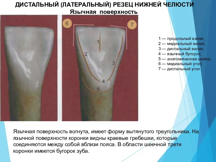 ДИСТАЛЬНЫЙ (ЛАТЕРАЛЬНЫЙ) РЕЗЕЦ НИЖНЕЙ ЧЕЛЮСТИ Язычная поверхность 1 — продольный валик; 2