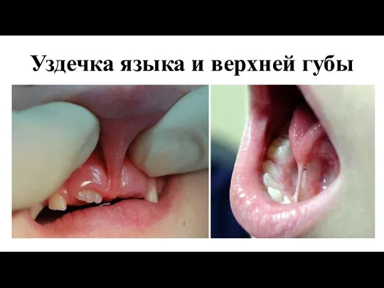 Уздечка языка и верхней губы