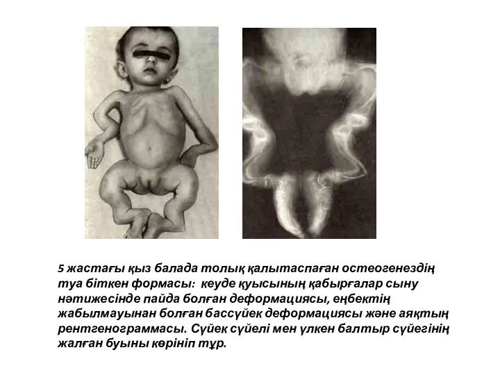 5 жастағы қыз балада толық қалытаспаған остеогенездің туа біткен формасы: кеуде қуысының