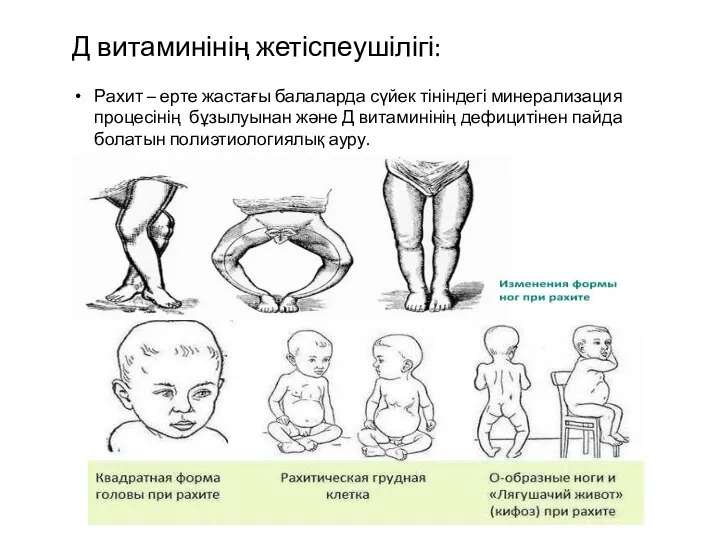 Д витаминінің жетіспеушілігі: Рахит – ерте жастағы балаларда сүйек тініндегі минерализация процесінің