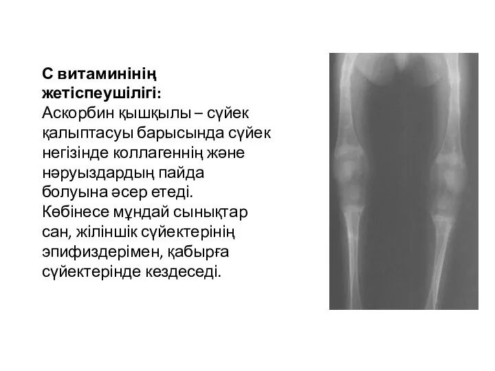 С витаминінің жетіспеушілігі: Аскорбин қышқылы – сүйек қалыптасуы барысында сүйек негізінде коллагеннің