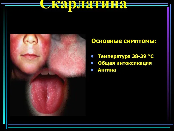 Скарлатина Основные симптомы: Температура 38-39 °C Общая интоксикация Ангина