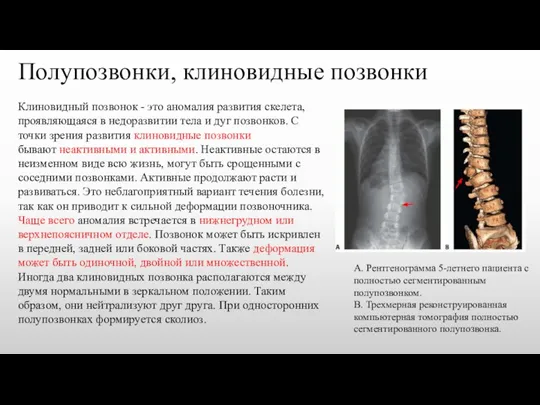 Полупозвонки, клиновидные позвонки Клиновидный позвонок - это аномалия развития скелета, проявляющаяся в