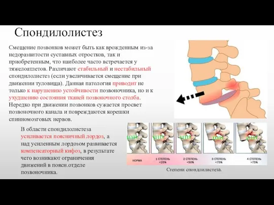 Спондилолистез Смещение позвонков может быть как врожденным из-за недоразвитости суставных отростков, так