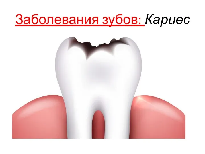 Заболевания зубов: Кариес