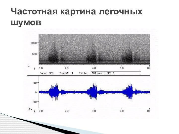 Частотная картина легочных шумов