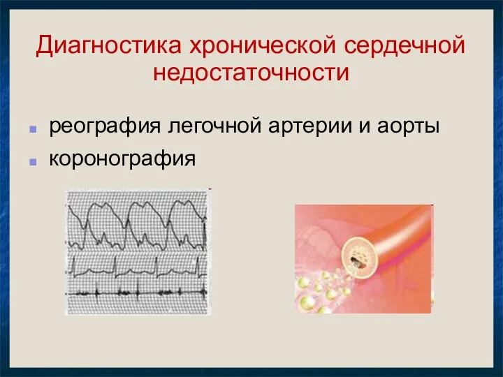 Диагностика хронической сердечной недостаточности реография легочной артерии и аорты коронография