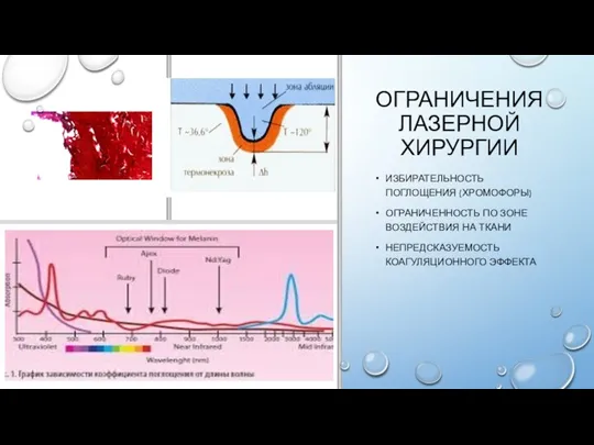 ОГРАНИЧЕНИЯ ЛАЗЕРНОЙ ХИРУРГИИ ИЗБИРАТЕЛЬНОСТЬ ПОГЛОЩЕНИЯ (ХРОМОФОРЫ) ОГРАНИЧЕННОСТЬ ПО ЗОНЕ ВОЗДЕЙСТВИЯ НА ТКАНИ НЕПРЕДСКАЗУЕМОСТЬ КОАГУЛЯЦИОННОГО ЭФФЕКТА