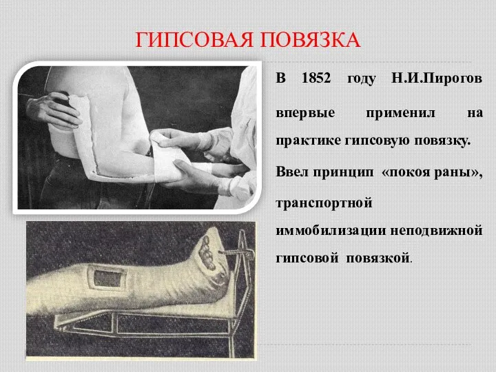 ГИПСОВАЯ ПОВЯЗКА В 1852 году Н.И.Пирогов впервые применил на практике гипсовую повязку.