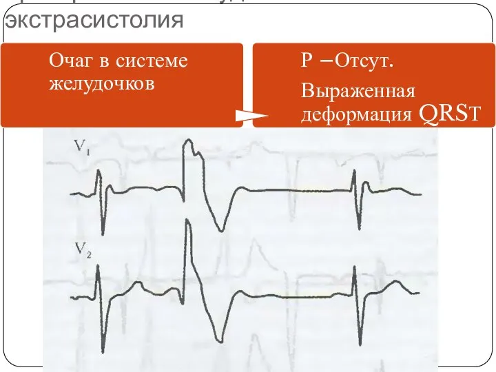 Критерии ЭКГ: желудочковая экстрасистолия