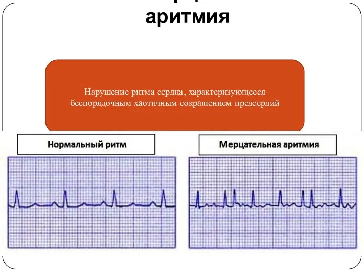 Мерцательная аритмия Нарушение ритма сердца, характеризующееся беспорядочным хаотичным сокращением предсердий