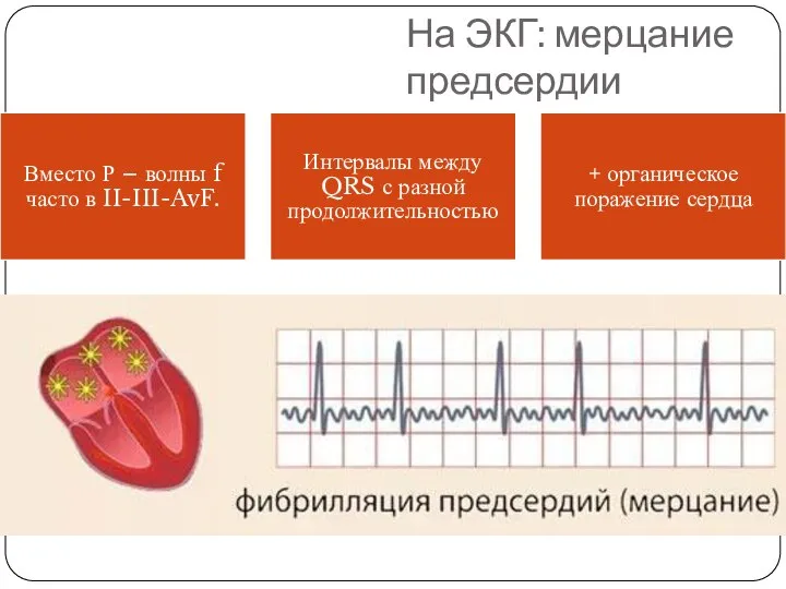 На ЭКГ: мерцание предсердии