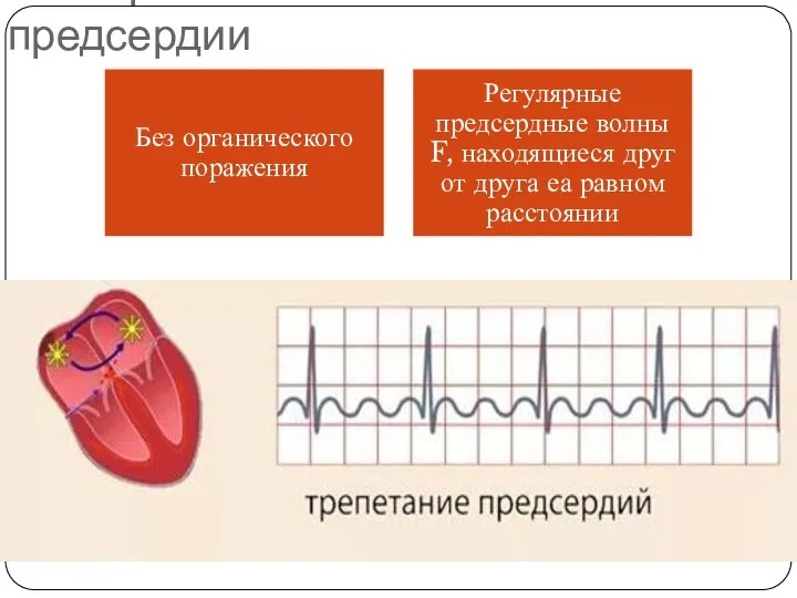 ЭКГ: трепетание предсердии