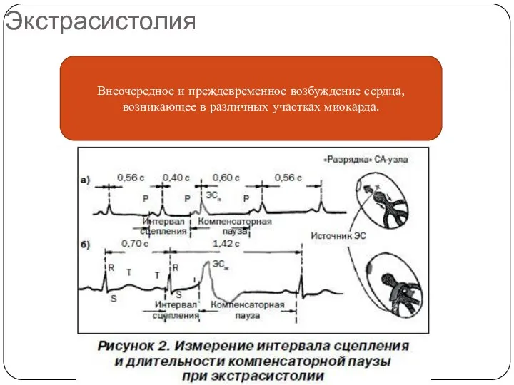 Экстрасистолия Внеочередное и преждевременное возбуждение сердца, возникающее в различных участках миокарда.