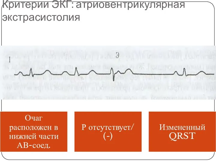 Критерии ЭКГ: атриовентрикулярная экстрасистолия