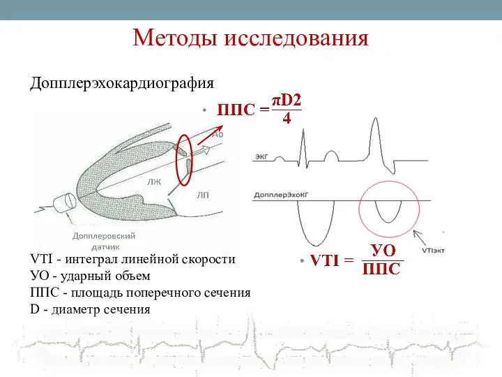 Методы исследования Допплерэхокардиография VTI - интеграл линейной скорости УО - ударный объем