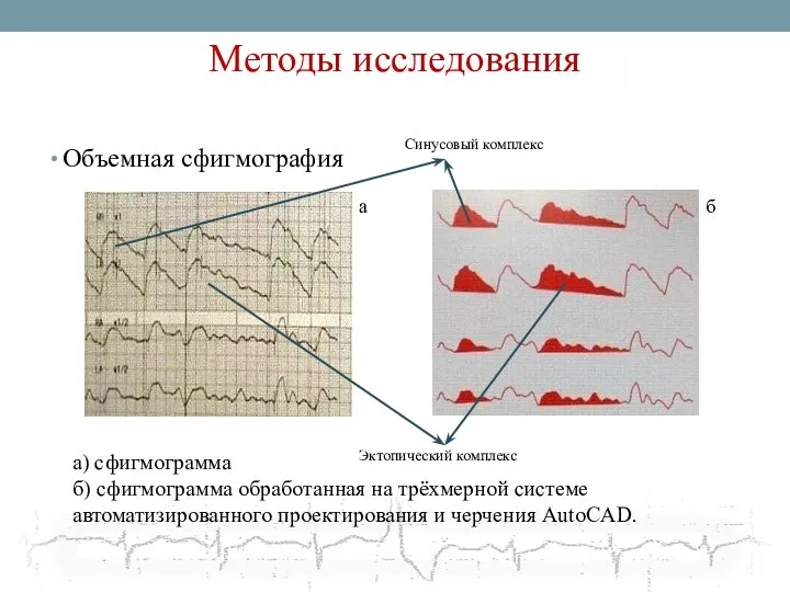 Методы исследования Объемная сфигмография а б а) сфигмограмма б) сфигмограмма обработанная на